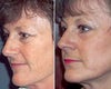 CO2 laser before & after photos