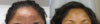 Vi Peel before & after photos