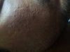 POCKMARKS ON FACE