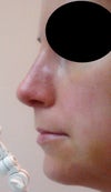 Left side: lump on left nasal sidewall (taken 1 min after cast removal 4 days ago and hasn't changed since)