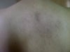 brown mark on back
