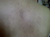 brown mark on back