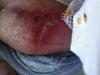 Inverted T right breast