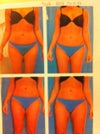 5 Weeks Post (inner thighs have dents and ridges)