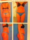 5 Weeks Post (flanks look worst if not same, there's a ridge on mid stomach, lower stomach above pubic area is bigger looks like ken doll)