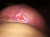 Left breast