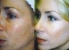 Photofacial Before and After Photos