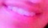 the pic shows the slanting of my teeth towards one side of my face plus overlapping of my front two teeth