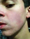 Side view (cheek)