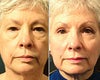 Cheek lift before & after photos