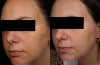 GentleLase Before and After Photos