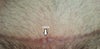 Is this part of the scar hypertrophic?