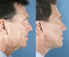 Lower face lift before & after photos