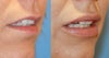 Lip implants before & after photos
