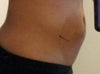 About and 90 minutes after procedure. Is the whole "pink" area going to be affected by the Coolsculpting?