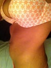 (A few days before christmas) That little fat pocket below my bra line is the BANE OF MY EXISTENCE! I have had this even before my daughter. Please tell me that it can be lipo'ed out?!?!?
