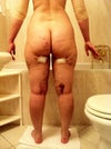 What I look like after lipo