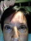 Swollen left eye