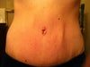 Vertical ripple on right side of belly button, slight ripple on top left as well, PO 4 weeks