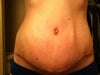 Post op
3 weeks