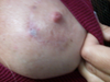 Benelli breast lift and open wound