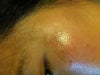 sun spots on the cheek