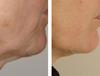TriPollar Before and After Photos