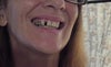 right side 1 tooth taken out 2 fix but not fixed right falling apart
gives me a metallic taste in my mouth