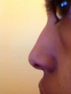 Never had that little bump before and there is a bit of a flat area off to the side. It is very hard to capture it on camera. You have to touch my nose to really feel the flat part and its off to the side too.