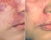 Pulsed dye laser before & after photos