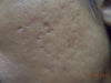 Scar on the left cheek