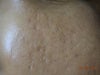 Scar on the right cheek