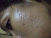 scar pits