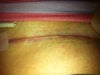 Tummy Tuck Scar