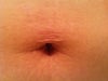 Belly button ring scar.