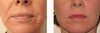 Liquid Facelift Before and After Photos