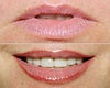 Lip Surgery before & after photos