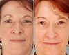Blue peel before & after photos