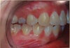 Side view of teeth