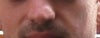 Appearance of my right nostril a year ago.