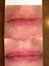 Before any treatment, 2nd photo is after 1st Vbeam from another practitioner.  Looks better