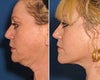 Quick Lift before & after photos