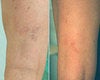 Asclera before & after photos