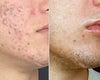 Smoothbeam laser before & after photos