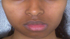 I have wide cheeks. I don't want the bulgy fat under the cheekbone and across the nosetip/mouth.