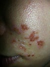 vinegar burn
