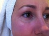 After 6 months under right eye hollow