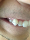 Partial covering of tooth by aligner.