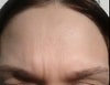 FOREHEAD