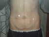 ideal weight for a male tummy tuck candidate?